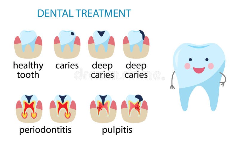 Diseases of teeth. caries, pulpitis, periodontitis. Vector illustration. Dental treatment poster. Icon Diseases of teeth. caries, pulpitis, periodontitis. Human royalty free illustration