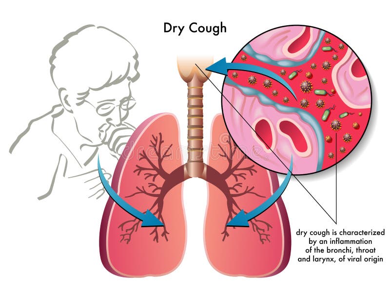 Dry cough royalty free illustration