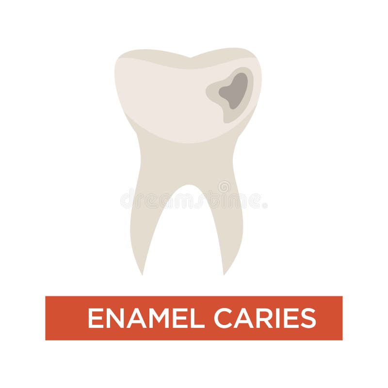 Enamel caries dental disease tooth damage dentistry. Dentistry enamel caries dental disease isolated vector tooth damage hole oral cavity health toothache vector illustration