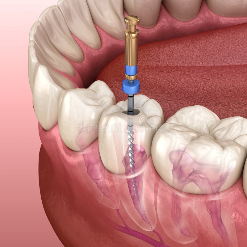 Endodontic root canal treatment process. Medically accurate tooth illustration stock illustration