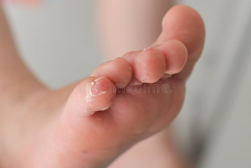 Enterovirus foot hand mouth Skin peeled off on the body of a child Cocksackie virus. Enterovirus foot hand mouth disease Skin peeled off on the legs of a child royalty free stock image