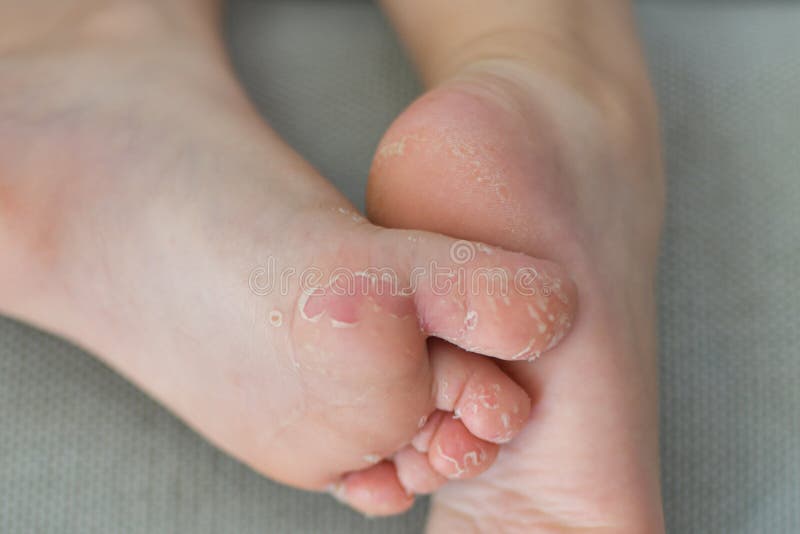 Enterovirus foot hand mouth Skin peeled off on the body of a child Cocksackie virus. Enterovirus foot hand mouth disease Skin peeled off on the legs of a child stock photos