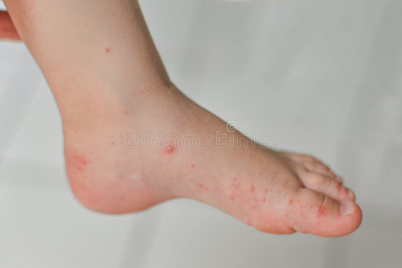 Enterovirus Leg arm mouth Rash on the body of a child Cocksackie virus. Enterovirus Legs hands mouth Rash on the body of a child Cocksackie virus royalty free stock photos