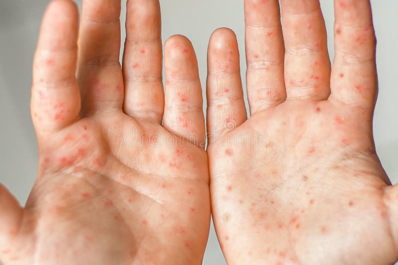 Enterovirus Leg arm mouth Rash on the body of a child Cocksackie virus. Enterovirus Legs hands mouth Rash on the body of a child Cocksackie virus stock images