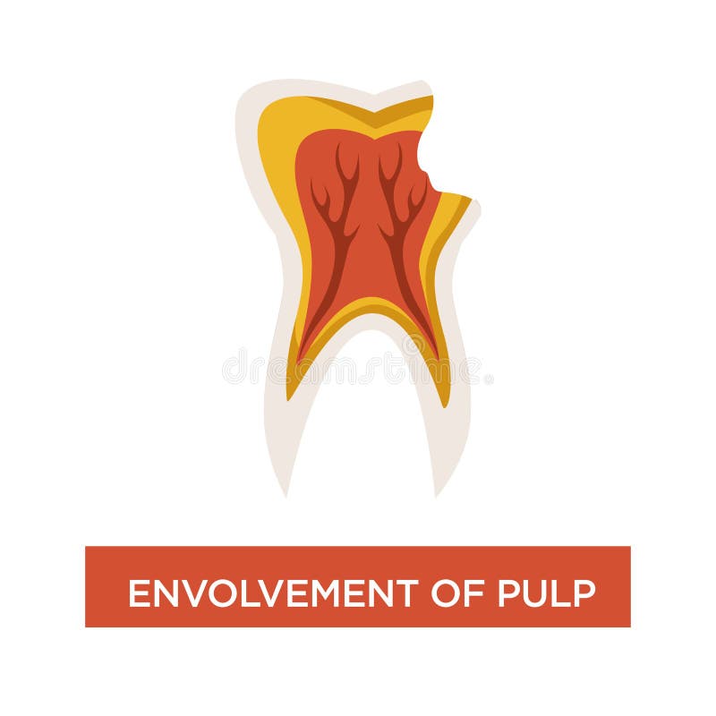 Envolvement of pulp dental disease mouth cavity dentistry. Dentistry envolvement of pulp dental disease mouth cavity isolated tooth vector teeth damage vector illustration
