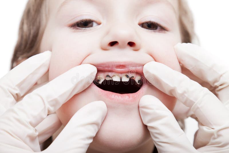 Examining caries teeth decay stock image