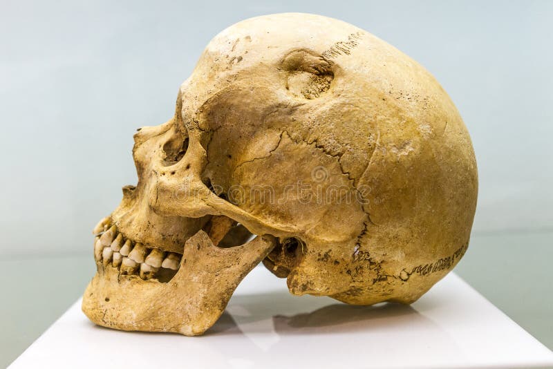 Exposed human skull. Human skull exposed on white sufface royalty free stock image