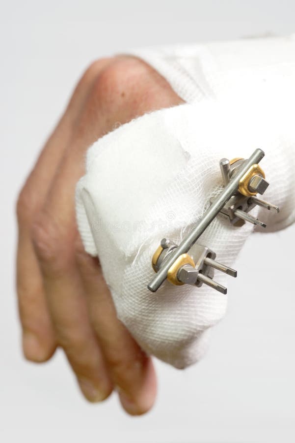 External rig to mend a broken hand. Close up of a Fractured hand with an external rig to mend a fractured pinky finger, four pins sticking outt of a broken royalty free stock photography
