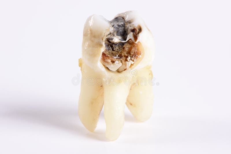 Extracted molar tooth. With massive caries stock photography