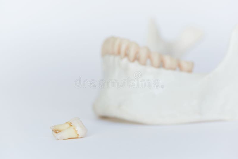 An extracted wisdom molar tooth ond jaw model. An extracted wisdom molar tooth ond human jaw model stock photo