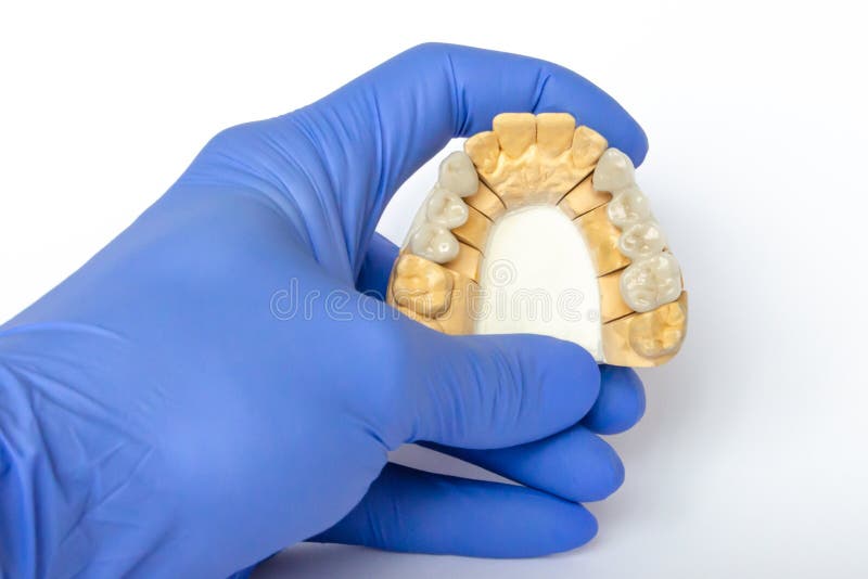 Fake teeth. ceramic teeth. dental bridges. orthopedic dentistry. cermet bridges are on the gypsum model after manufacturing. Plaster model with teeth in the stock photos