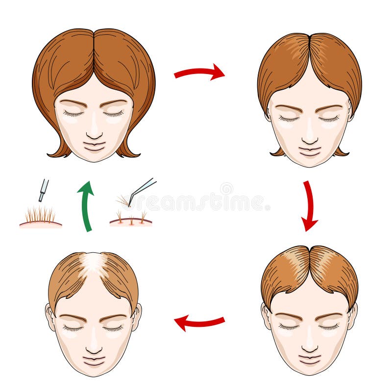 Female hair loss and transplantation icons stock illustration