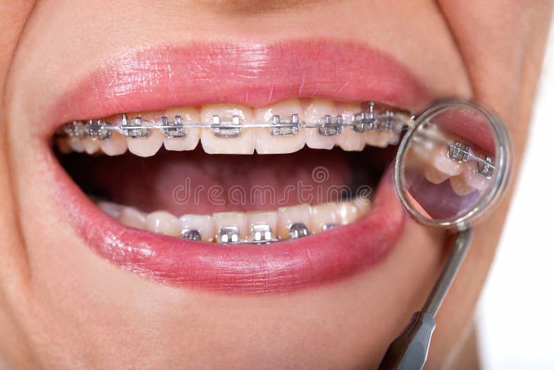 Female patient showing her lingual braces on dental mirror. Lingual braces on dental mirror, close up stock photos