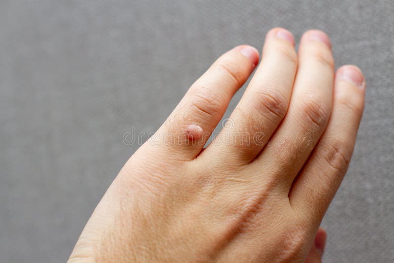 Finger wart on hand. Health concept. body wart stock images