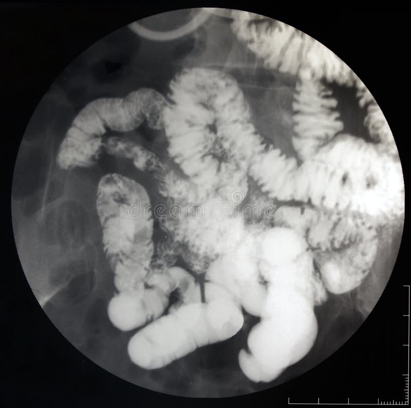 Fluoroscopic X-ray of the small intestine royalty free stock photo