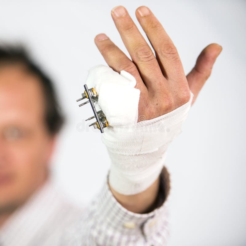 Fractured pinky finger. Fractured hand with an external fixture attached to the pinky royalty free stock photography