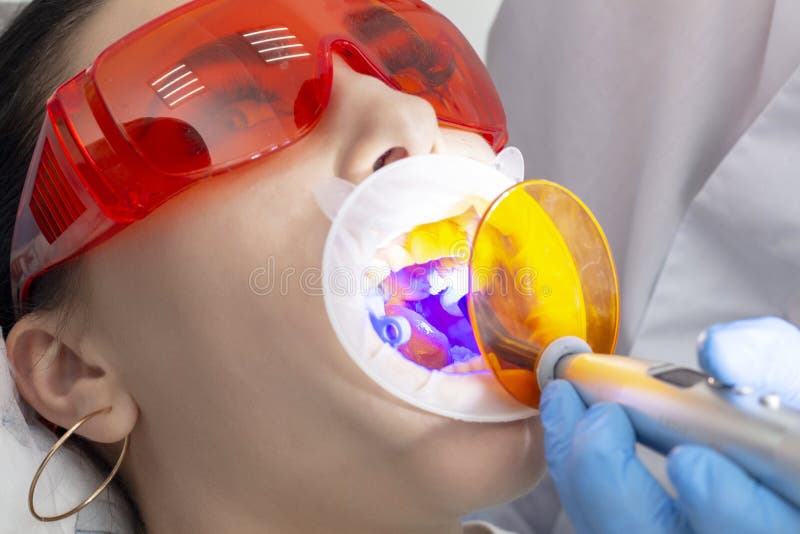 Girl on preventive reception at  dentist. The doctor polymerizes the filling material in the patient`s tooth. treatment of caries stock image