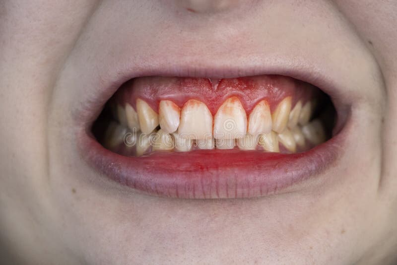 Gum bleeding and inflammation close up. A man examined by a dentist. The diagnosis of gingivitis royalty free stock images