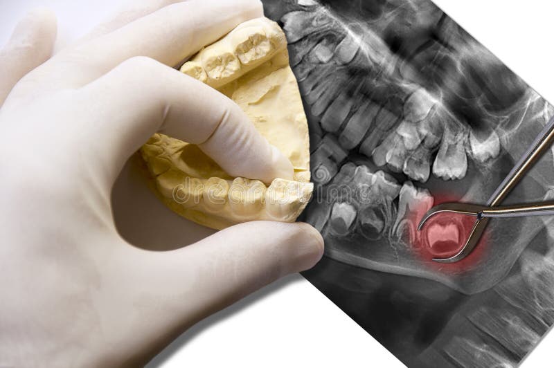 Hand show molar tooth and toothache wisdom tooth. Hand show molar tooth and toothache stock photography