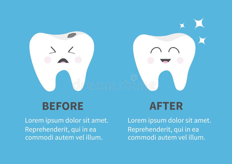 Healthy smiling tooth icon. Shining star. Crying bad ill teeth with caries. Before after Infographic Template with text. Cute char. Acter. Oral dental hygiene stock illustration