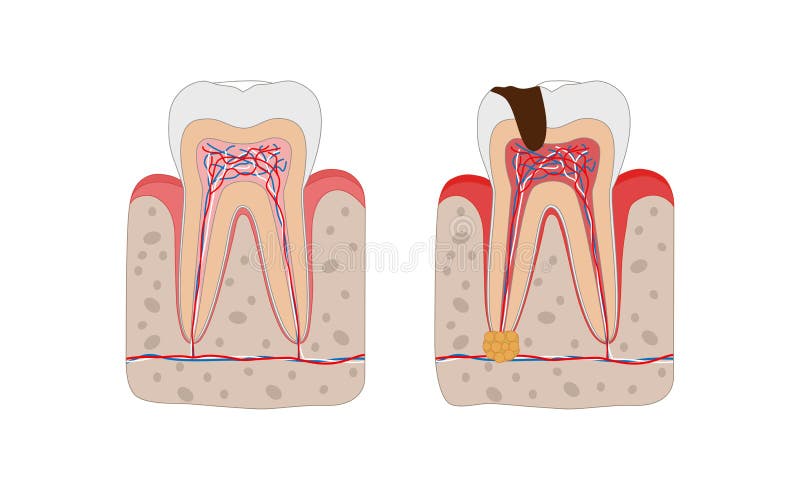 Healthy tooth and unhealthy tooth with tooth decay and dental abscess infographic elements isolated on white background. Medical dental poster illustration in vector illustration