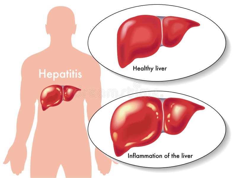 Hepatitis stock illustration