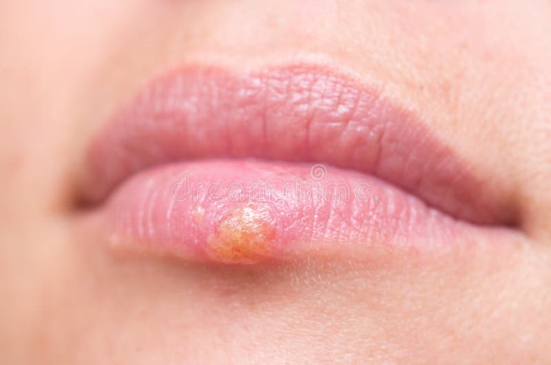 Herpes on lips stock photography