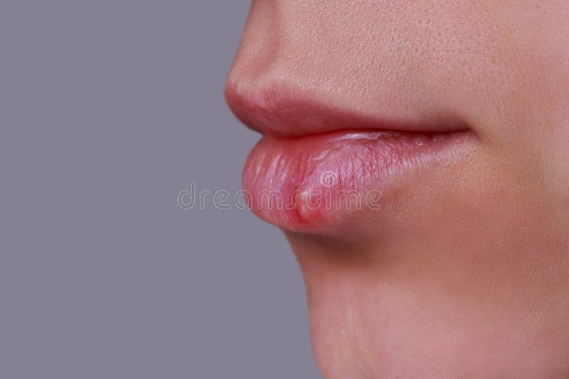 Herpes on the lips royalty free stock photography