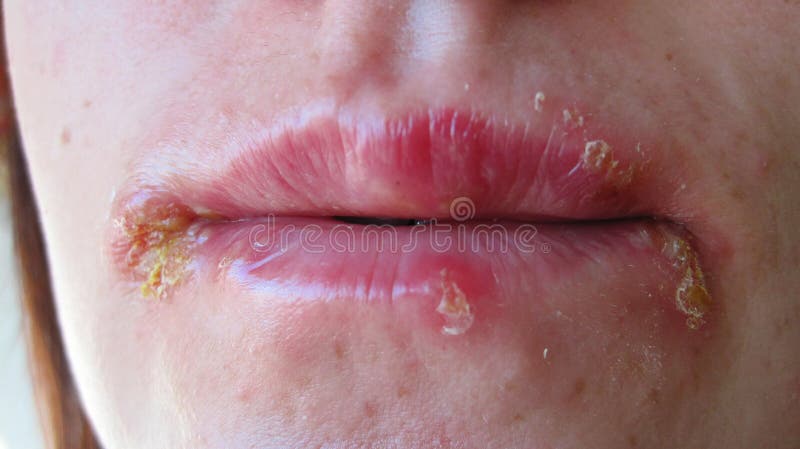 Herpes on lips royalty free stock photo
