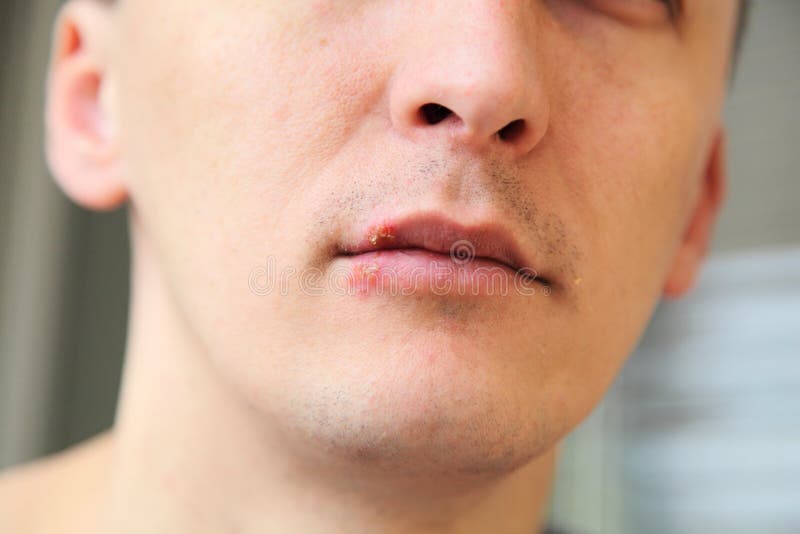 Herpes on the lips royalty free stock photos