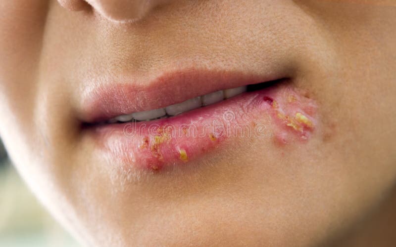 Herpes on the lips stock photography