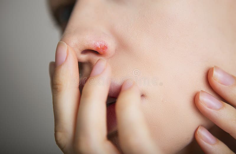 Herpes on the nose - young woman with herpes on her nose royalty free stock photo