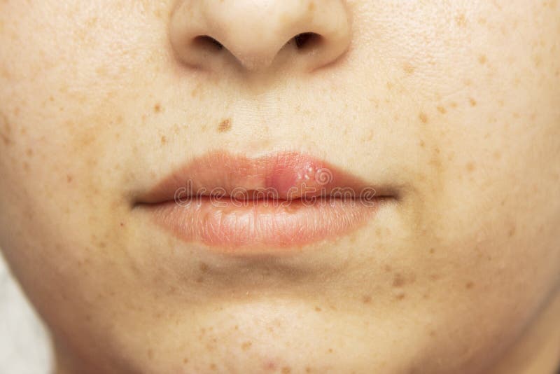 Herpes oral cold sore blisters on the lips- herpes simplex royalty free stock photos