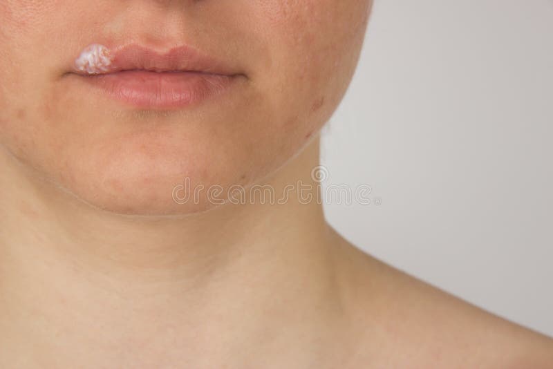 Herpes with pus on the lips of a young girl and pimples on the f royalty free stock image