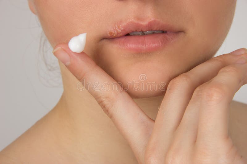 Herpes sore with pus on the lips of the young beautiful girl and stock photo