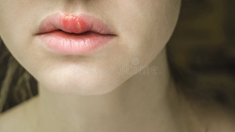 Herpes Simplex Virus on the Upper Lip of a Young Beautiful Woman. Herpes Labialis. Medical Background stock photography