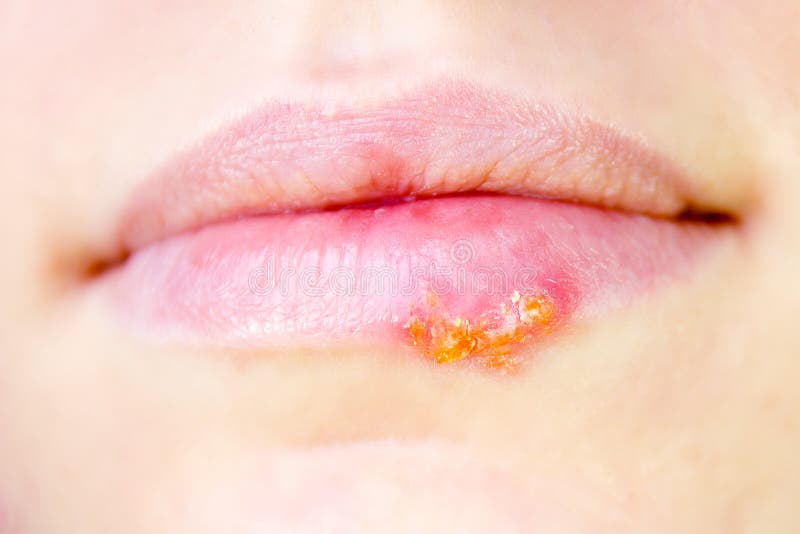 Herpes virus on female lips stock images