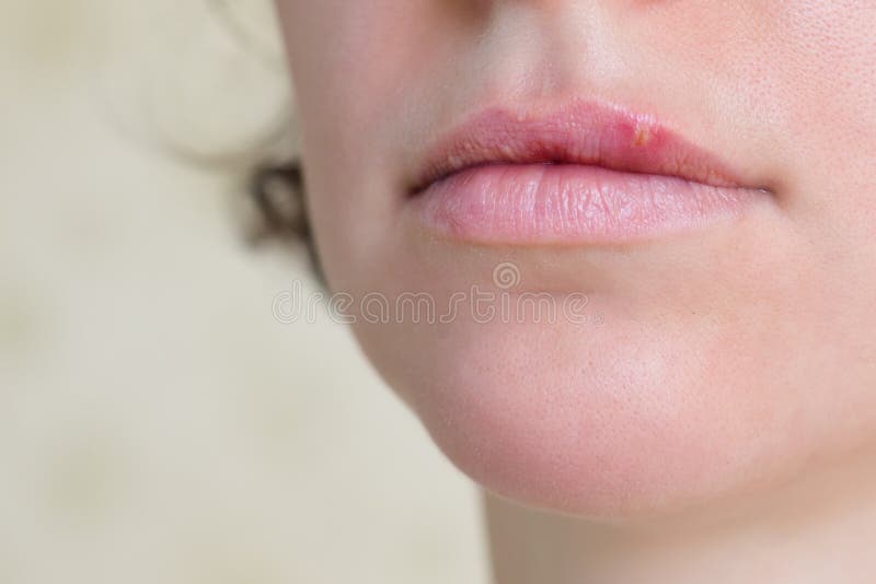 Herpes virus on female lips stock photo