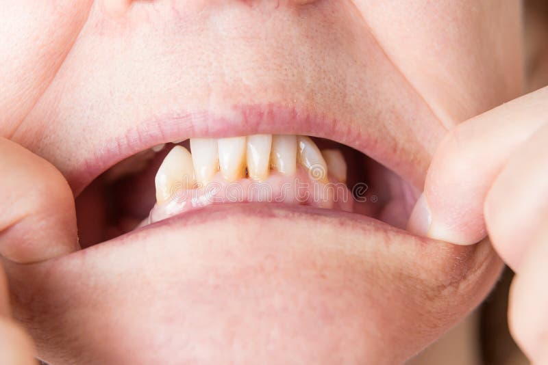 Lower bottom back teeth missing with front exposed. Horizontal close up image of bottom molar teeth missing on both sides with front teeth showing and are stock photography