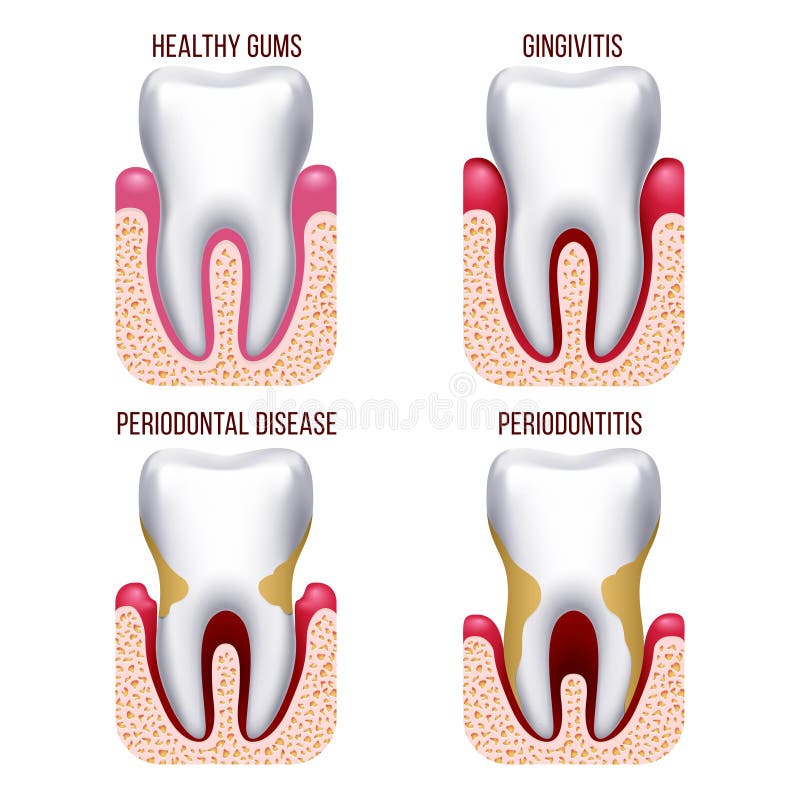 Human gum disease, gums bleeding. Tooth prevention dental, oral care vector infographics. Human gum disease, gums bleeding. tooth disease prevention dental, oral vector illustration