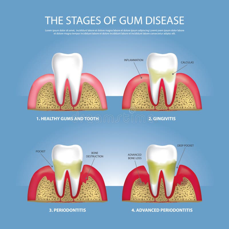 Human teeth Stages of Gum Disease. Vector Illustration stock illustration