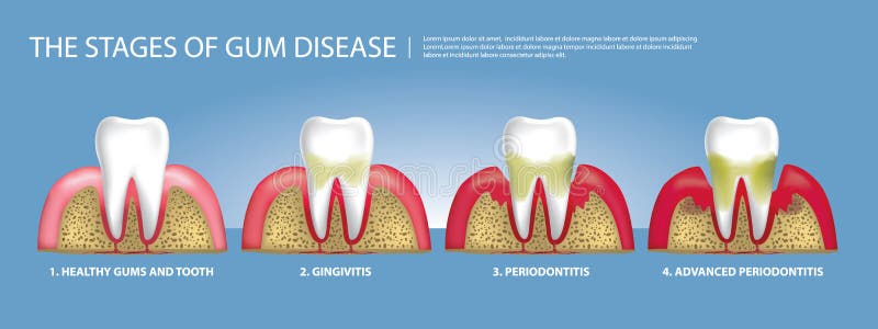 Human teeth Stages of Gum Disease. Vector Illustration vector illustration