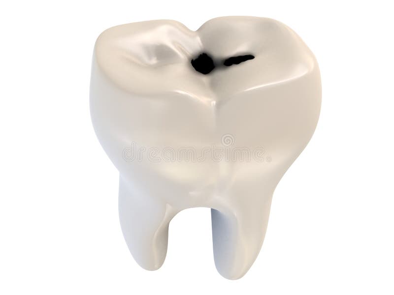 Human tooth with caries. 3d rendered illustration of a human tooth with caries stock illustration