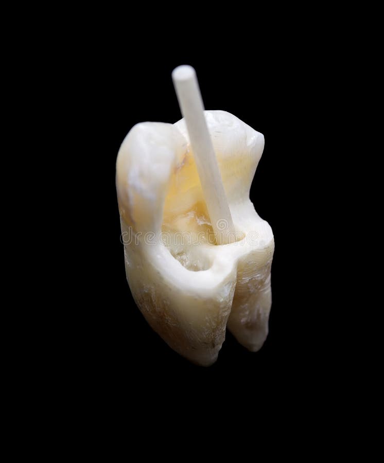 Human tooth with fiber resin post. Extracted molar tooth with fiber resin post royalty free stock image