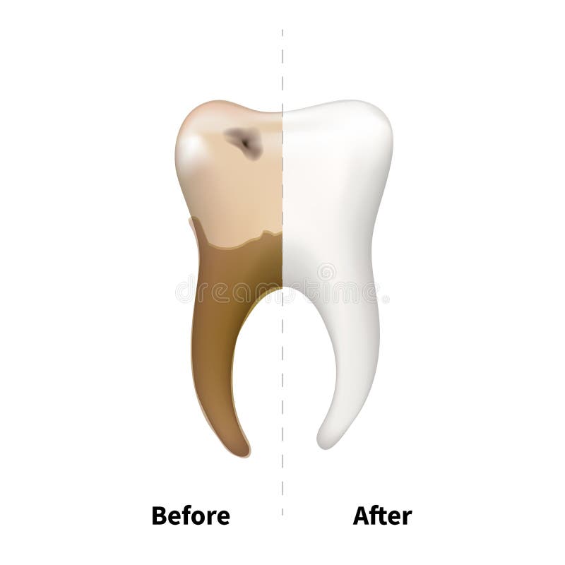 Human tooth with old sick side with caries and bright white healthy another, teeth treatment dental concept isolated on. Human tooth with old sick side with royalty free illustration