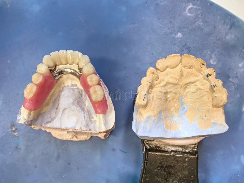 Implantation, gypsum jaw with ceramic dentures royalty free stock images