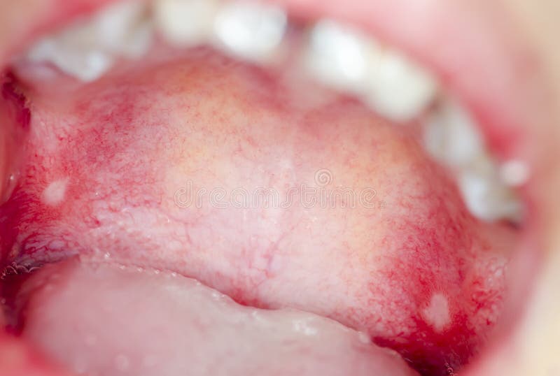 Infection of ulcer inside mouth royalty free stock photo