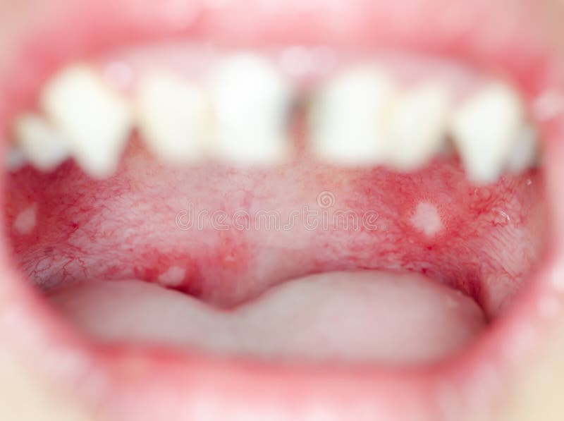Infection of ulcer inside mouth royalty free stock image
