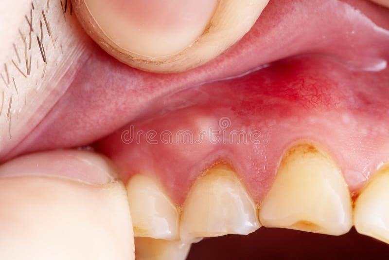 Inflammation of the gums abscess closeup,. Teeth in poor condition with caries stock photography