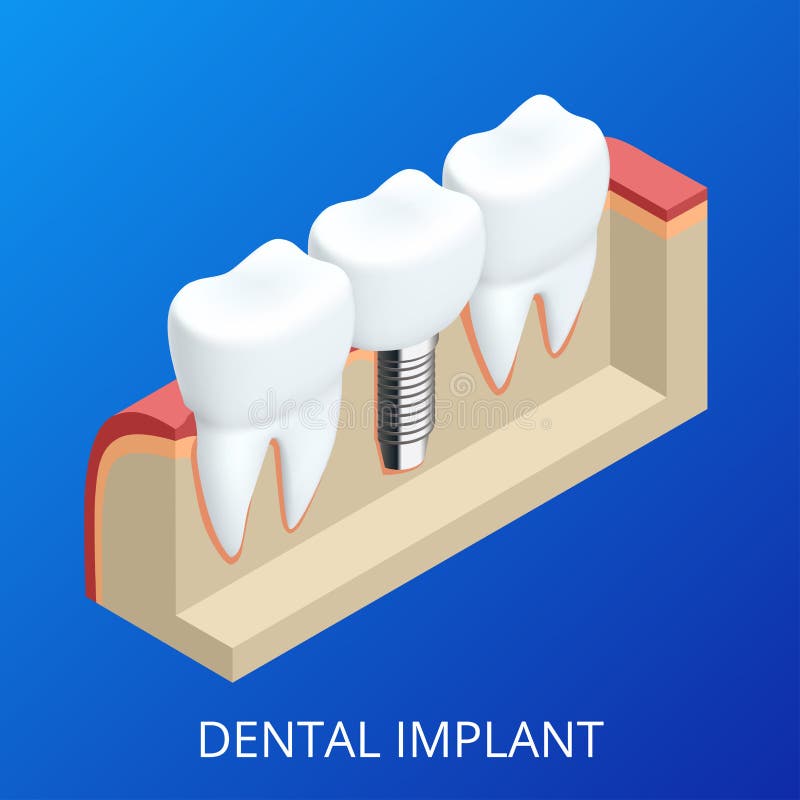 Isometric Tooth human implant. Dental concept. Human teeth or dentures. 3d illustration Isolated. Realistic vector stock illustration